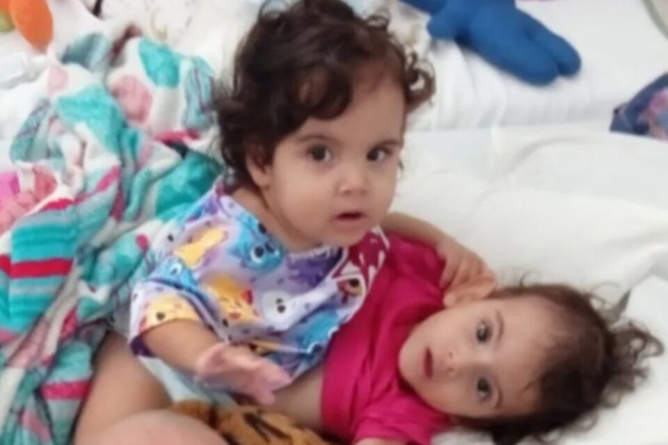 Siamesa sobrevivente: Aruna segue em estado grave, mas em 'desmame gradual da sedação'