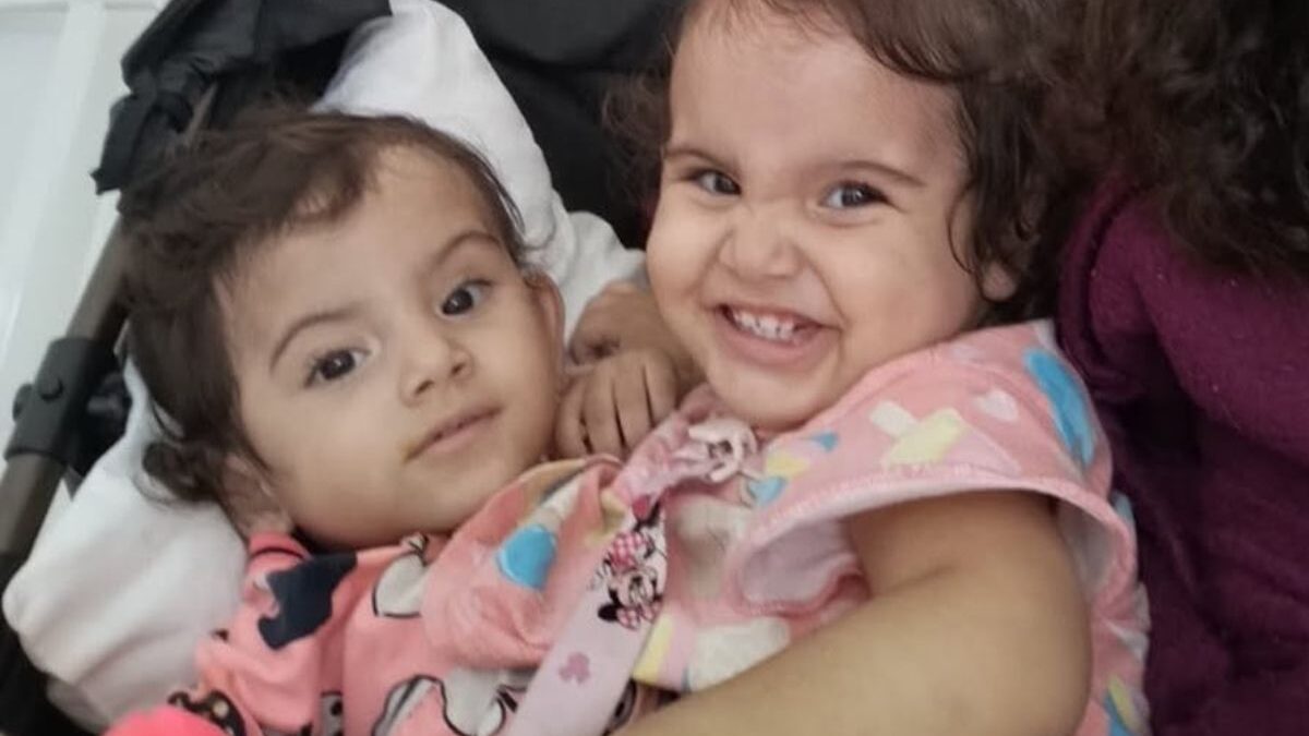 Gêmeas siamesas Kiraz e Aruna: cirurgia concluída com sucesso (Foto: Reprodução)