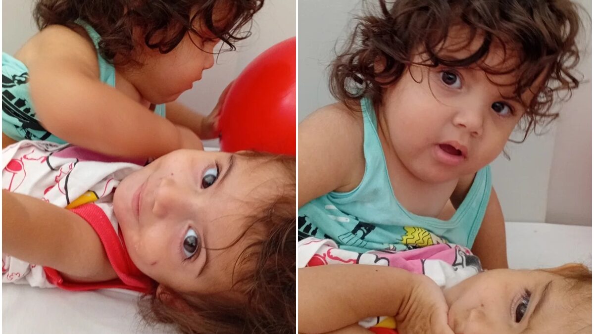 Gêmeas siamesas separadas em Goiânia têm estado grave, mas estável e dentro do esperado