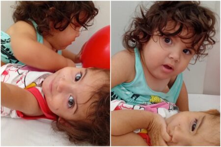 Gêmeas siamesas separadas em Goiânia têm estado grave, mas estável e dentro do esperado