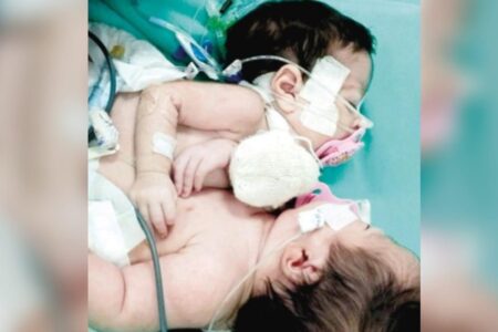 Siamesas de Manaus recebem alta da UTI, em Goiânia