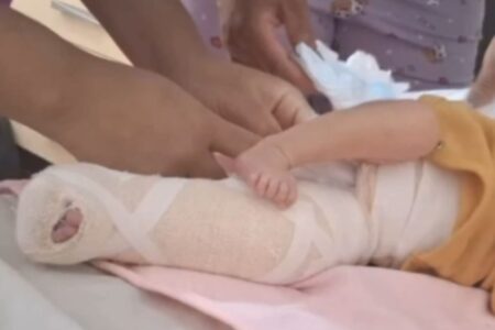 Fratura no fêmur sob investigação (Foto: Reprodução)