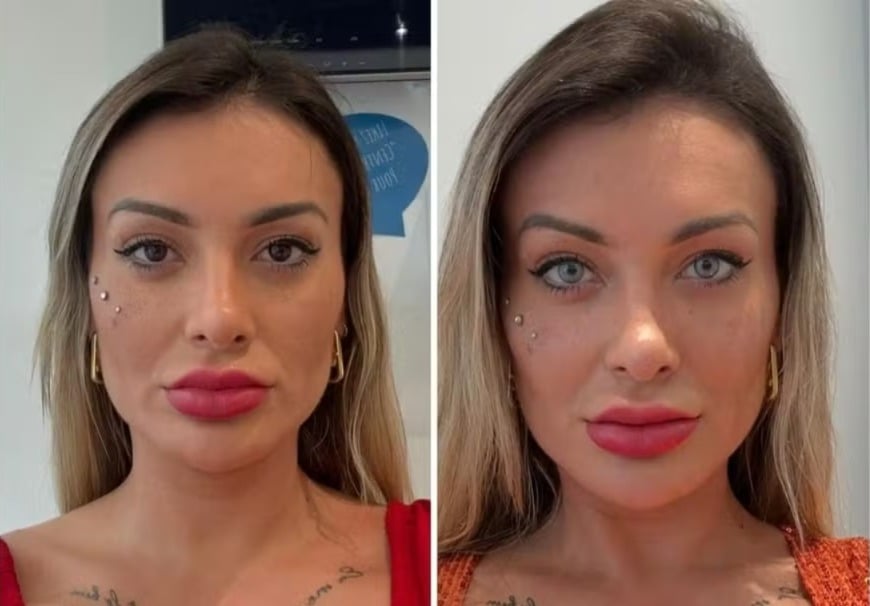 Andressa Urach faz cirurgia proibida no Brasil e mostra resultado; veja antes e depois Maya Massafera também realizou o mesmo procedimento