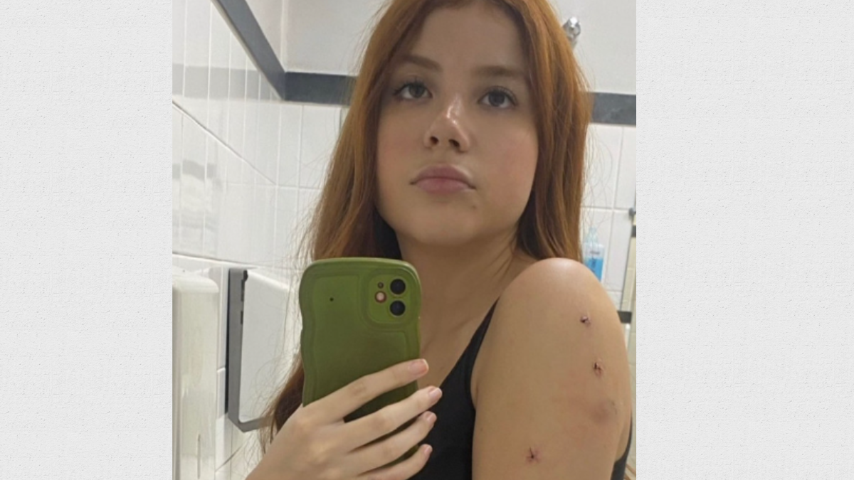 Imagem de Laura Sabino com pontos no braço