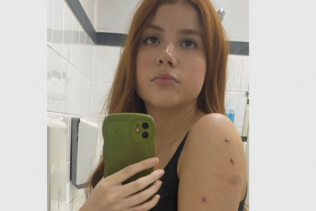 Imagem de Laura Sabino com pontos no braço