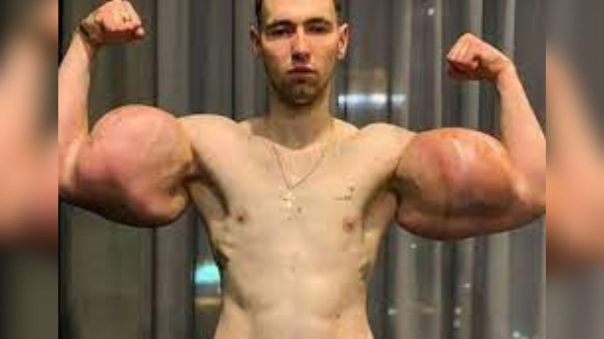 Popeye russo mostra os braços antes da cirurgia de remoção (Foto: Reprodução)