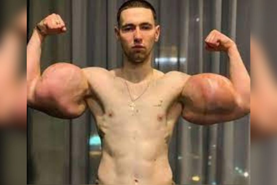 Popeye russo mostra os braços antes da cirurgia de remoção (Foto: Reprodução)