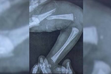 Recém-nascida tem fêmur fraturado durante teste do pezinho, em Aparecida Fratura foi confirmada dois dias depois do teste