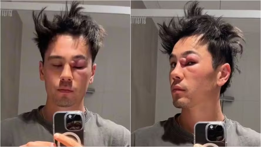 Influencer confunde cisto com espinha e fica com o rosto desfigurado; veja foto Situação levou quase nove meses para ser resolvida