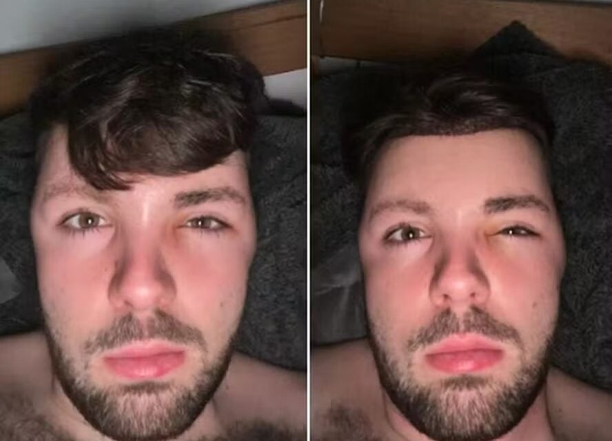 Homem fica com o rosto deformado ao ignorar proibição de sexo após transplante capilar; veja foto pesquisei DST, achei que tinha pego algo