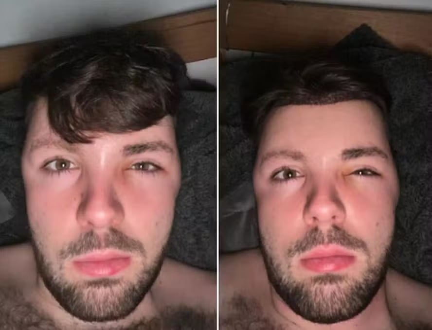 Homem fica com o rosto deformado ao ignorar proibição de sexo após transplante capilar; veja foto pesquisei DST, achei que tinha pego algo