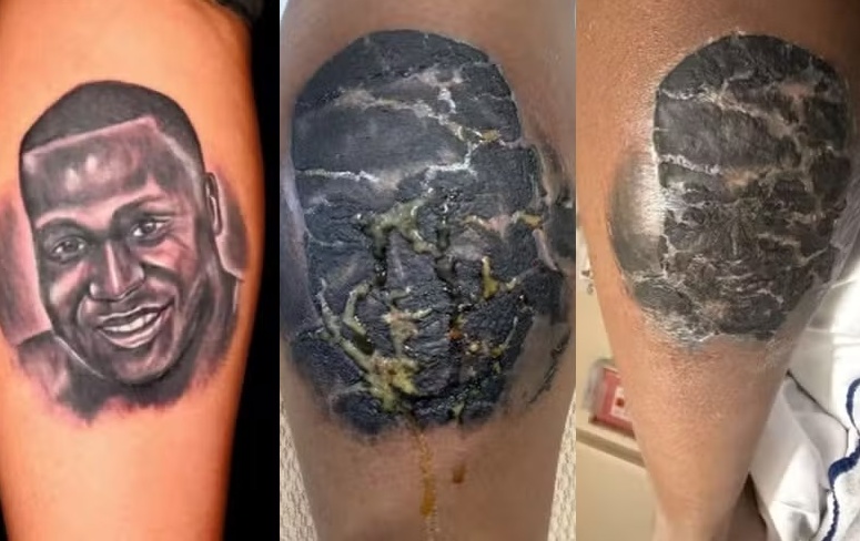 Mulher tatua rosto do irmão falecido, mas infecção desfigura o desenho; veja Tatuagem celulite bacteriana por infecção de pele