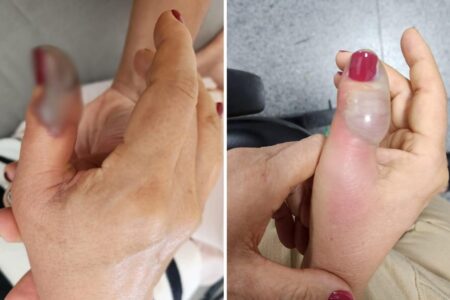 Idosa vai fazer a unha em salão de Goiânia e perde ponta de dedo após infecção