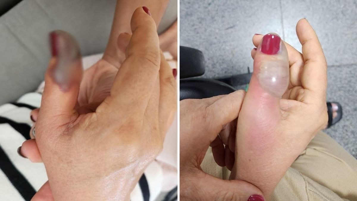 Idosa vai fazer a unha em salão de Goiânia e perde ponta de dedo após infecção