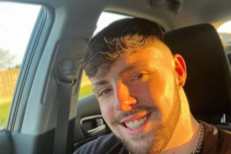 Homem fica com o rosto deformado ao ignorar proibição de sexo após transplante capilar; veja foto pesquisei DST, achei que tinha pego algo