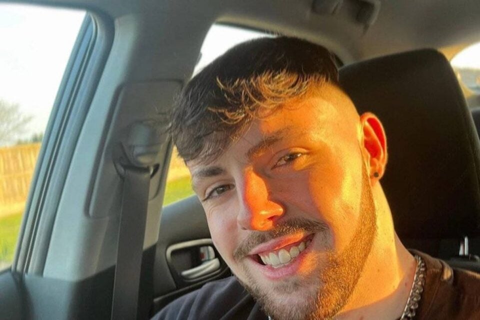 Homem fica com o rosto deformado ao ignorar proibição de sexo após transplante capilar; veja foto pesquisei DST, achei que tinha pego algo