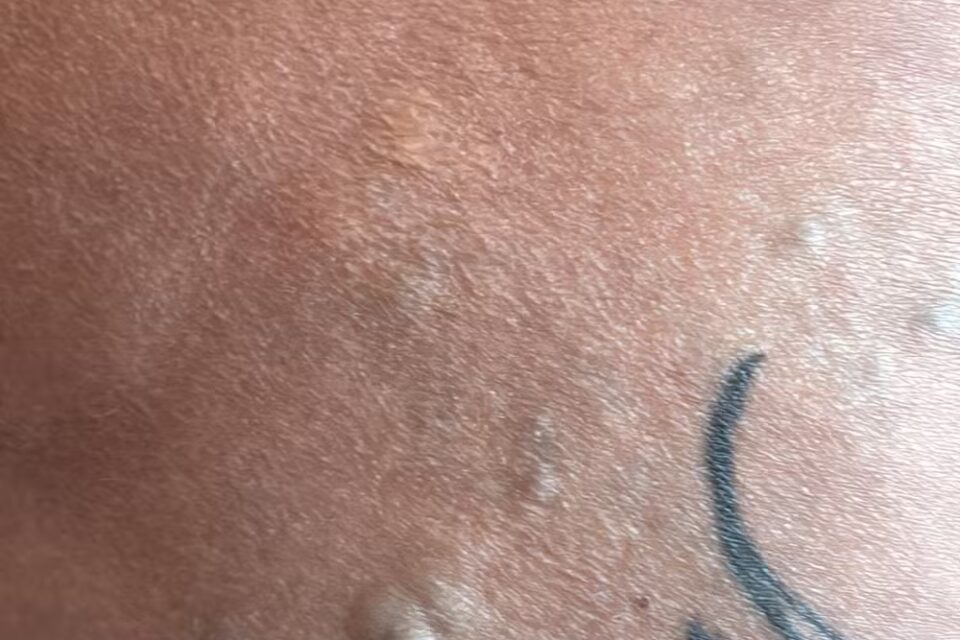 Juju Ferrari mostra como ficou o bumbum após infecção (Foto: Arquivo Pessoal)