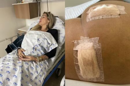 Juju Ferrari mostra como ficou o bumbum após infecção (Foto: Arquivo Pessoal)