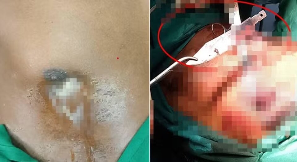 Homem reclama de dores nos mamilos e médico encontra lâmina alojada há oito anos Paciente explicou como objeto foi parar ali