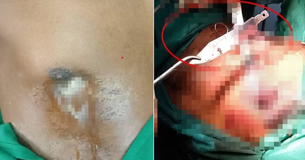 Homem reclama de dores nos mamilos e médico encontra lâmina alojada há oito anos Paciente explicou como objeto foi parar ali
