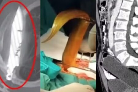 Veja os itens inusitados encontrados dentro de corpo de pacientes Teve até DIU 'desaparecido' por 12 anos...