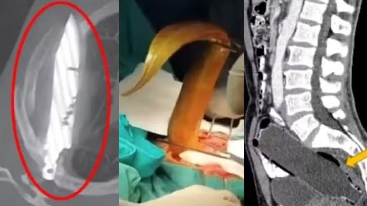 Veja os itens inusitados encontrados dentro de corpo de pacientes Teve até DIU 'desaparecido' por 12 anos...