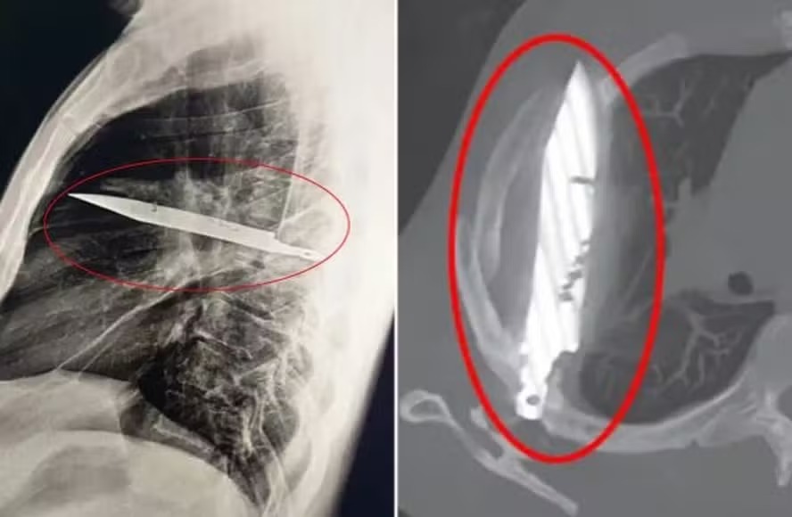 Homem reclama de dores nos mamilos e médico encontra lâmina alojada há oito anos Paciente explicou como objeto foi parar ali