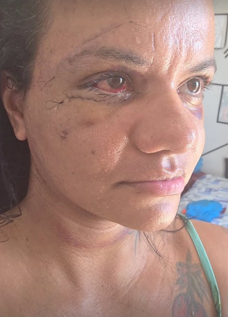 Mulher agredida com mais de 60 socos divulga foto após cirurgia para reconstrução da face; veja