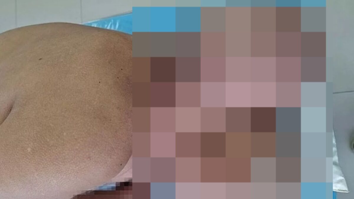 Imagens fortes: cirurgiões retiram tumor gigante de paciente: "Parecia outra cabeça" Homem passou 16 anos passando remédios caseiros