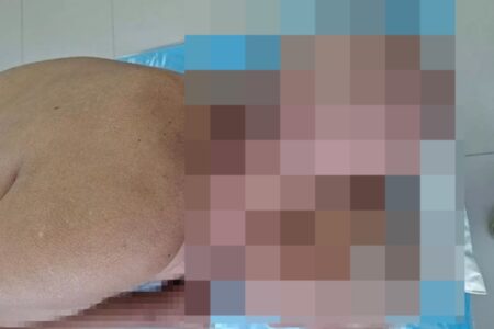 Imagens fortes: cirurgiões retiram tumor gigante de paciente: "Parecia outra cabeça" Homem passou 16 anos passando remédios caseiros