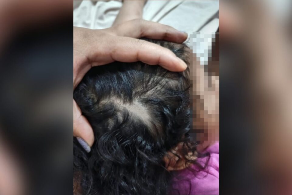 Imagem de um dos ferimentos na criança