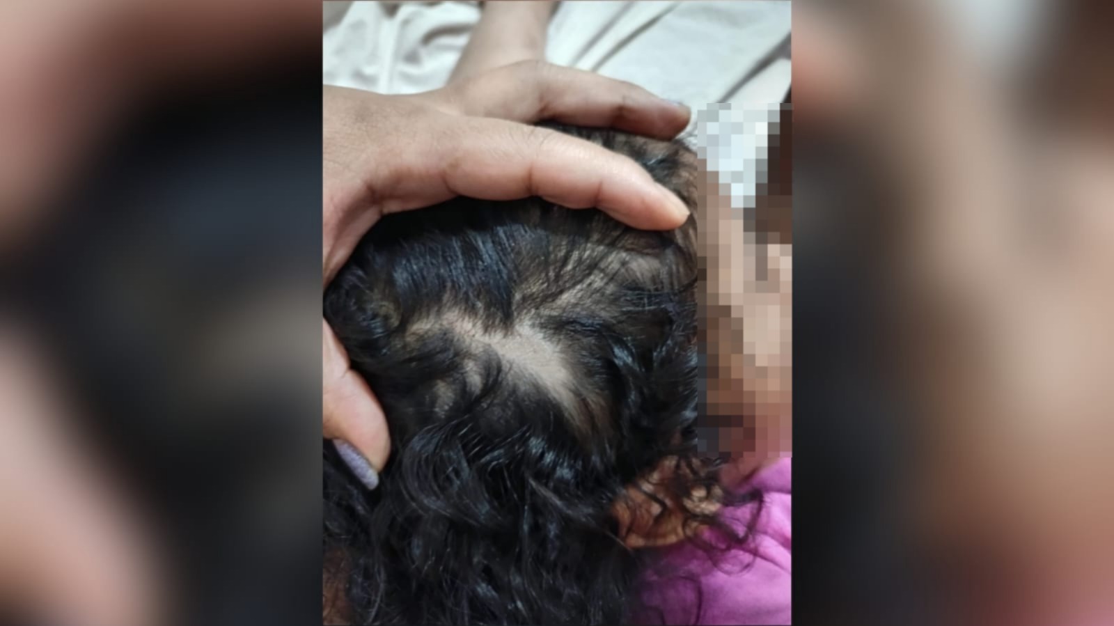 Imagem de um dos ferimentos na criança