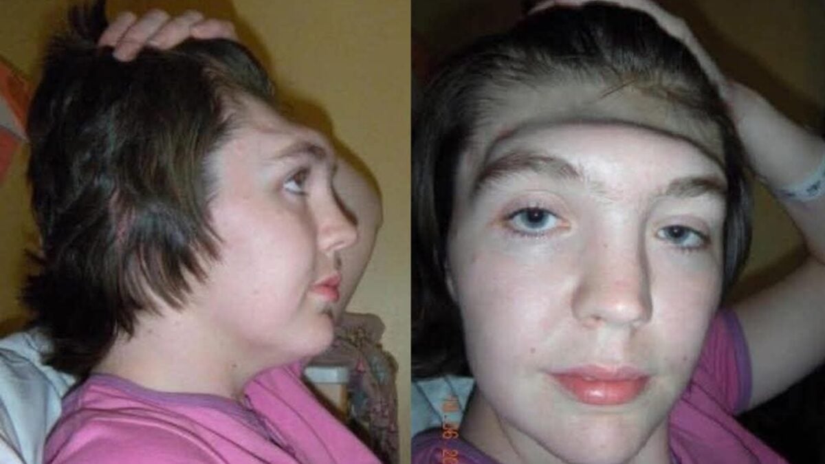 no banco do carona quando veículo bateu em muro Mulher perde a testa em acidente de carro e faz alerta: pessoas cometem o mesmo erro que ela