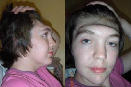 no banco do carona quando veículo bateu em muro Mulher perde a testa em acidente de carro e faz alerta: pessoas cometem o mesmo erro que ela