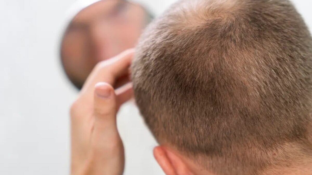 Medicamento em fase de testes mostra potencial para reverter calvície Loção pode estar disponível no mercado em 2027