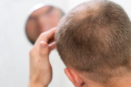 Medicamento em fase de testes mostra potencial para reverter calvície Loção pode estar disponível no mercado em 2027