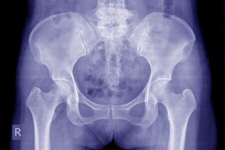 Mulher descobre objeto alojado em nádega por 22 anos; saiba o que era Chinesa relembrou o que fez com que o objeto entrasse em seu corpo