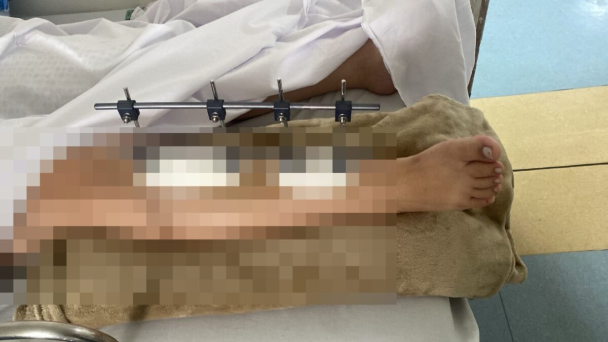 Imagem da perna da jovem atropelada