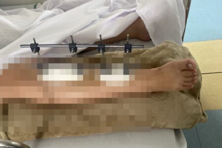 Imagem da perna da jovem atropelada