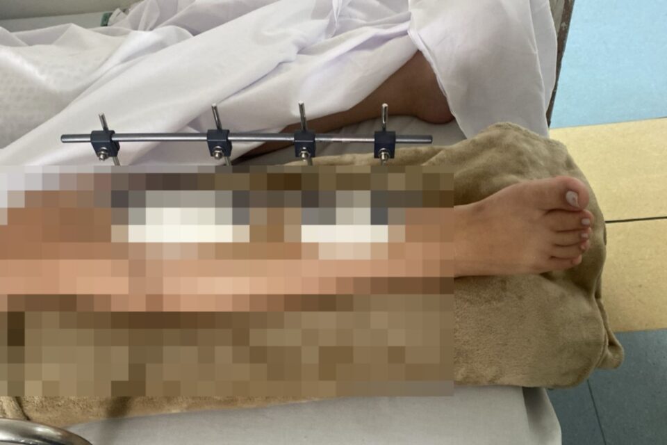 Imagem da perna da jovem atropelada