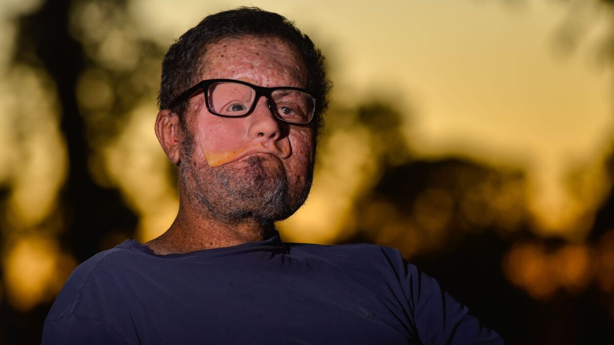 xeroderma pigmentoso aumenta o risco de câncer de pele. Foto: Jucimar de Sousa