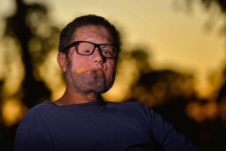 xeroderma pigmentoso aumenta o risco de câncer de pele. Foto: Jucimar de Sousa