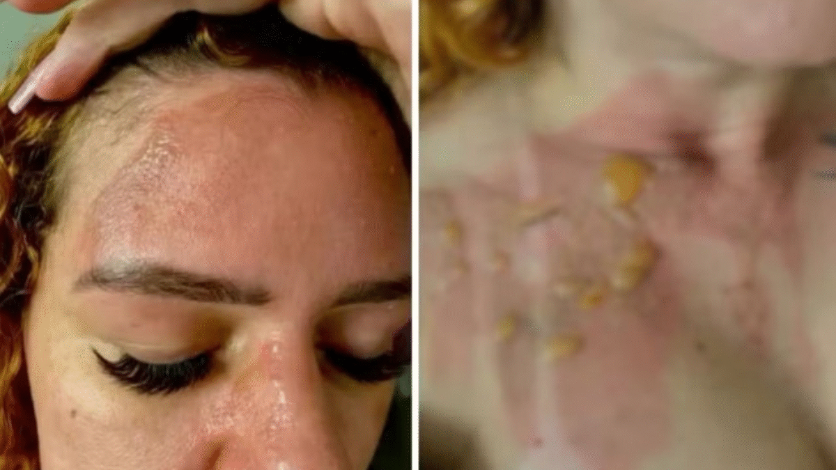 Imagem da empresária com o rosto queimado