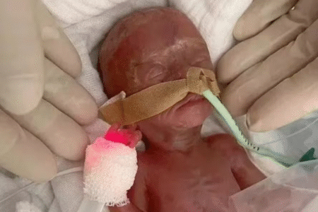 'Milagre': bebê nasce 16 semanas antes do previsto na Alemanha e sobrevive (Foto: Hospital de Magdenburgo)