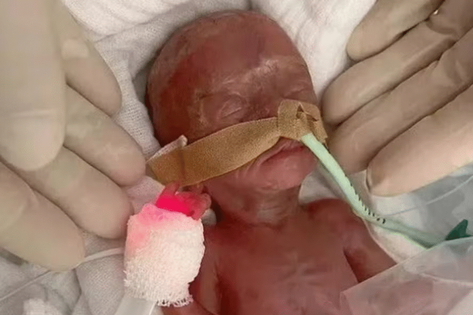 'Milagre': bebê nasce 16 semanas antes do previsto na Alemanha e sobrevive (Foto: Hospital de Magdenburgo)