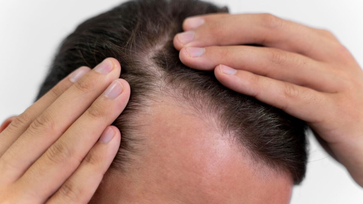 Adeus à calvície: ingrediente comum na cozinha ajuda no crescimento do cabelo; veja qual cebola casos de alopecia