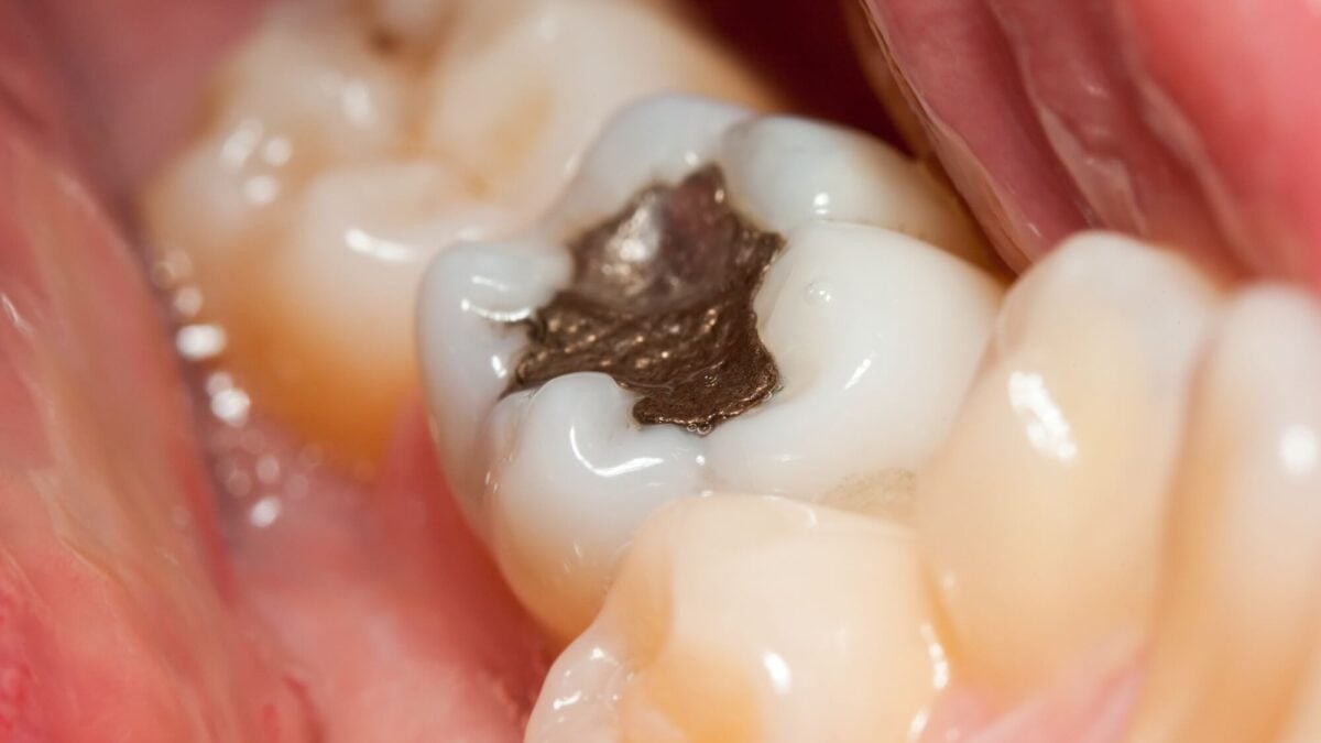 Brasil vai parar de usar restaurações prateadas nos dentes; veja motivo Quem tem obturações antigas não precisa trocar risco à saúde