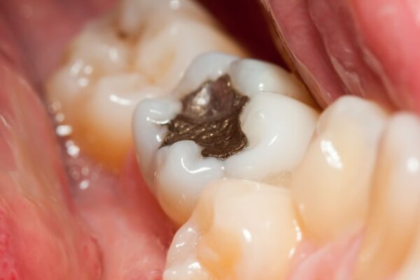 Brasil vai parar de usar restaurações prateadas nos dentes; veja motivo Quem tem obturações antigas não precisa trocar risco à saúde