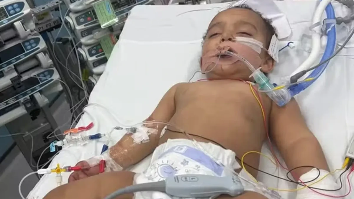 Bebê sofre ataque cardíaco e perde a língua após confundir mamadeira com soda cáustica Criança se alimenta por um tubo permanente no estômago