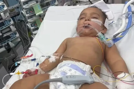 Bebê sofre ataque cardíaco e perde a língua após confundir mamadeira com soda cáustica Criança se alimenta por um tubo permanente no estômago